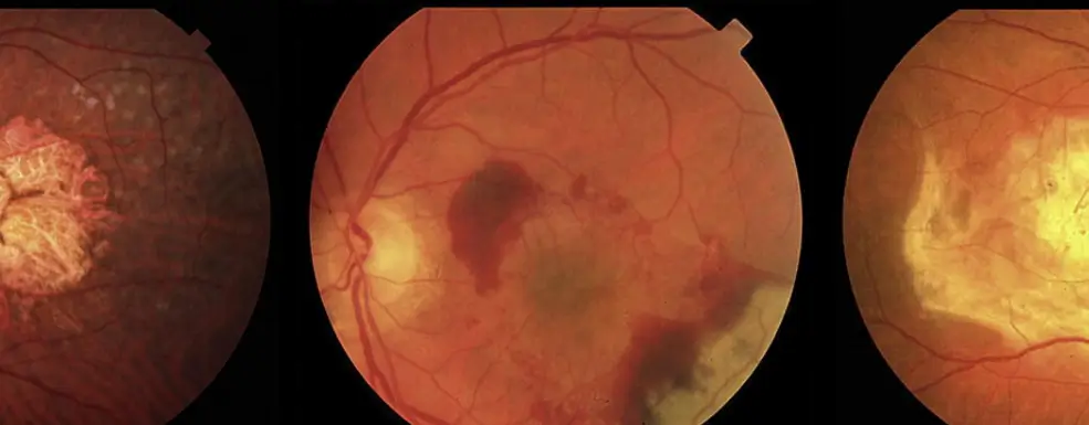 Example of Age-related Macular Degeneration